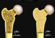 أعراض هشاشة العظام عند الكبار والأطفال