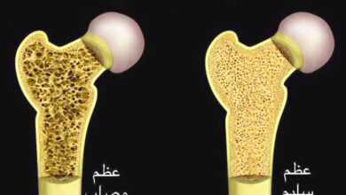 أعراض هشاشة العظام عند الكبار والأطفال