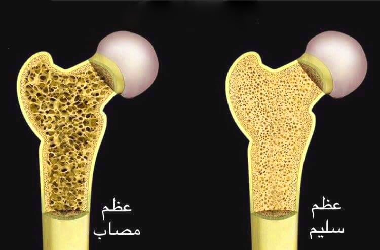 أعراض هشاشة العظام عند الكبار والأطفال