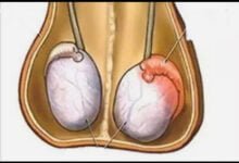 ألم الخصية اليمنى