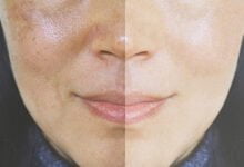 التخلص من اسمرار الشمس