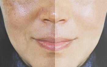 التخلص من اسمرار الشمس