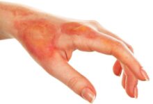 الحروق من الدرجة الأولى