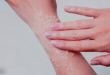 تقشير الجسم وتبييضه