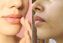 إزالة السواد حول الفم بسرعة رهيبة