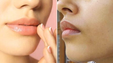 إزالة السواد حول الفم بسرعة رهيبة