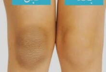 طريقة تبيض الركب