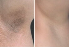 طريقة تبييض تحت الإبط