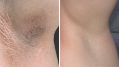 طريقة تبييض تحت الإبط