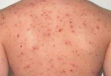 أعراض الإيدز وما أصله؟