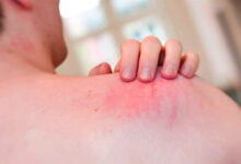 أعراض الحكة العقيدية؟