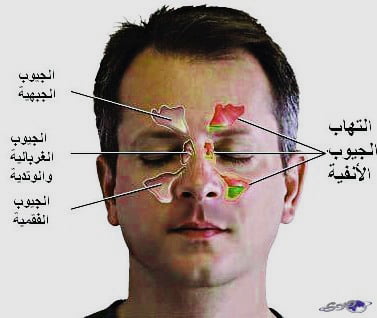 أنواع التهاب الجيوب الأنفية: تعرّف على النوعين المختلفين