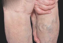 دوالي الساقين تزيد خطر جلطة الساق ‫والانسداد الرئوي