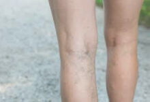 دوالي الساقين قد تهدد حياتك‬