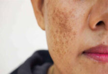 ظهور البقع الجلدية: الأسباب والعلاج وكيفية الوقاية منها؟