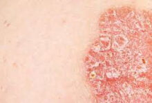 هل الصدفية معدية؟