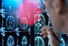 دراسة تكشف عن معدل انخفاض العمر المتوقع لمرضى التوحد