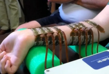 رقاقة إلكترونية تساعد مشلولا على تحريك يده