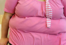 انقطاع النفس الانسدادي جراحات السمنة تقلل خطر الوفاة