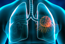 تقليل خطر سرطان الرئة من خلال الأنظمة الغذائية قليلة الدهون