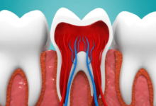 متى تحتاج السن بعد علاج عصبها إلى تركيب؟