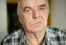 شلل الوجه المحيطي: أسباب، أعراض، وسبل العلاج