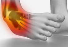 إصابات الكاحل الأعراض والعلاج